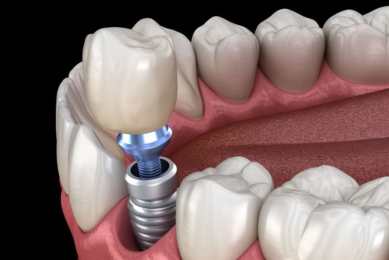 dental implant model