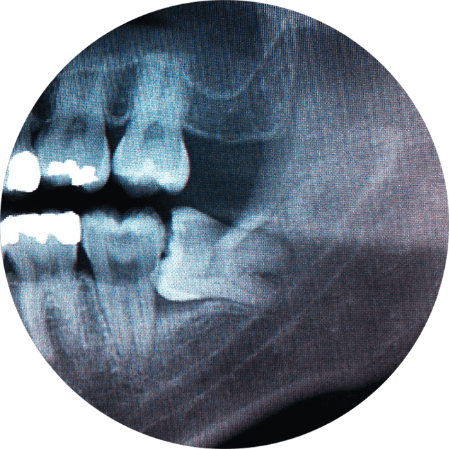 wisdom tooth graphic